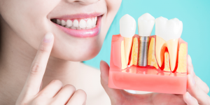 woman smiling with bone grafting diagram