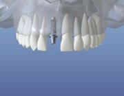 implant placed