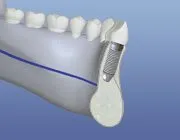 dental implant