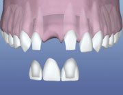 Dental Bridge