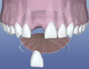 a dental implant flipper