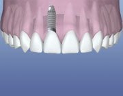 Dental Implant