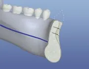 grafted bone