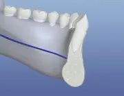 bone graft