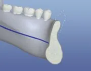 tooth loss