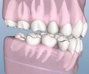 crowding from wisdom teeth