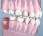 wisdom teeth cyst