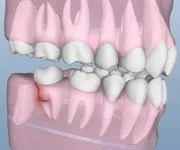 wisdom teeth damage