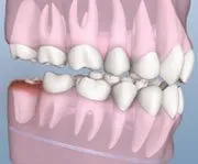 infected wisdom teeth